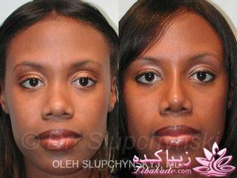 جراحی بینی - جراحی زیبایی